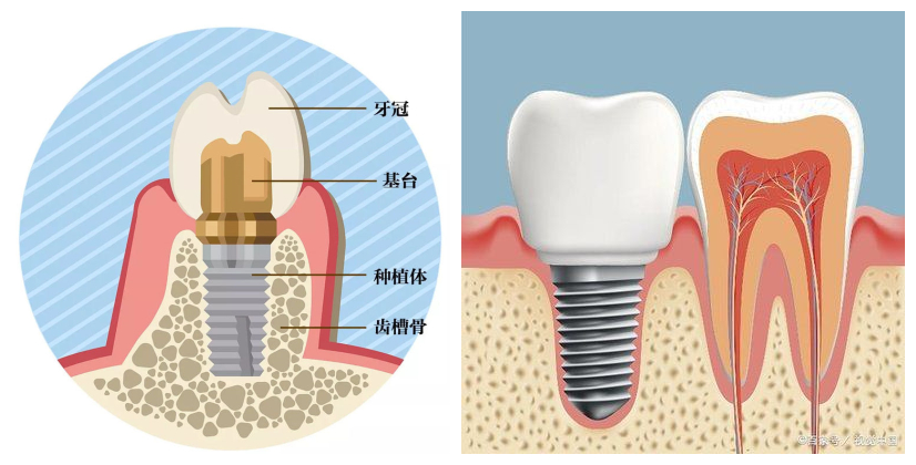 【口腔科新业务】种植牙-人类的第三副牙齿