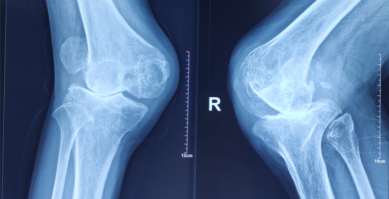骨二科成功完成一例高难度人工膝关节置换术