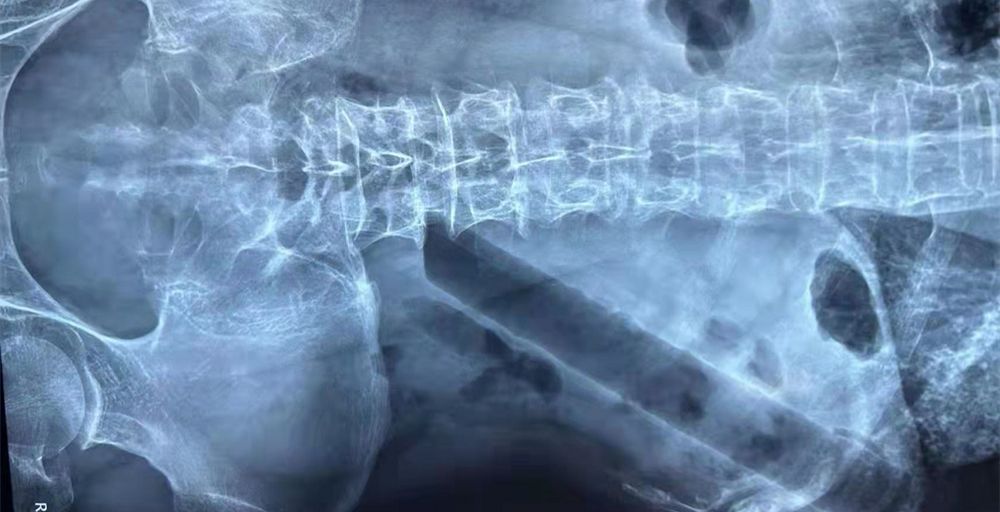 肛肠二科成功完成一例高难度结肠异物取出术